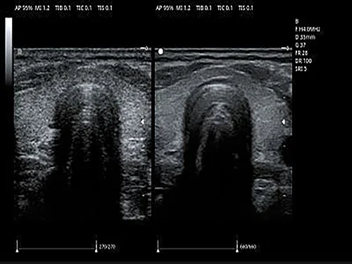 Гармоническая визуализация с инверсией импульса PIHI