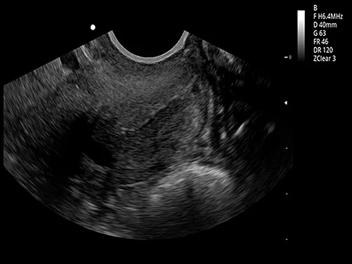 Автоматическое измерение толщины комплекса интима-медиа. IMT